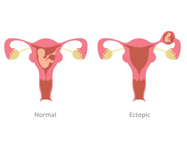 Ectopic Pregnancy Management
