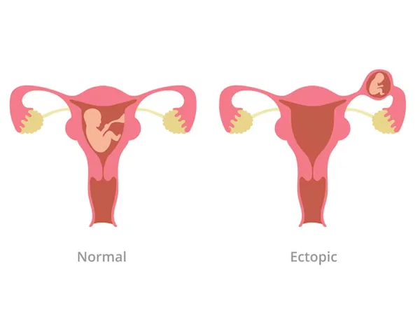 Ectopic Pregnancy Management