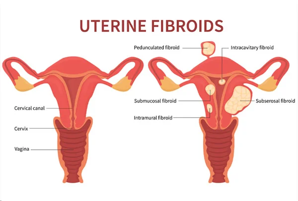Fibroids