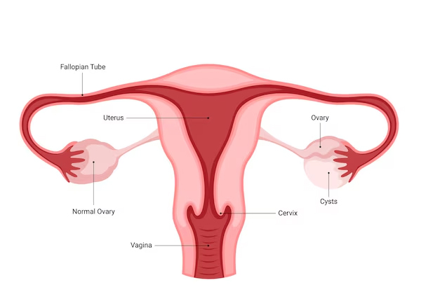 Ovarian Cyst