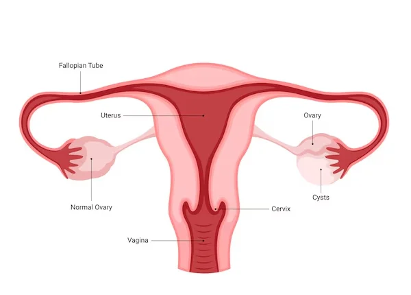 Ovarian Cyst