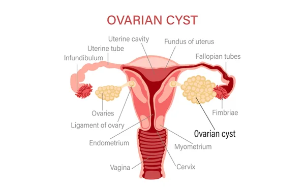 Ovarian Cystectomy